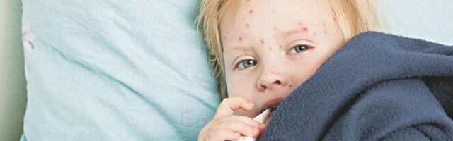 Novi slučaj malih boginja u Beogradu: Zaražen četvorogodišnjak, u prestonici ukupno devetoro obolelih