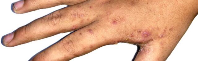 ŠUGA u Beogradu: Bolest se širi Srbijom, evo koji su simptomi