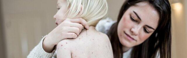 ZARAŽENO SEDAM BEBA I DVE ODRASLE OSOBE: Još jedan slučaj morbila u Smederevu