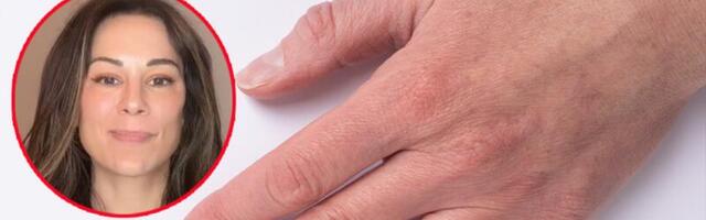 JEDNA PROMENA NA NOKTIMA MOŽE DA UKAŽE NA RAK! Dermatolog upozorava "Veća je šansa da će biti benigna ako je svetlija"