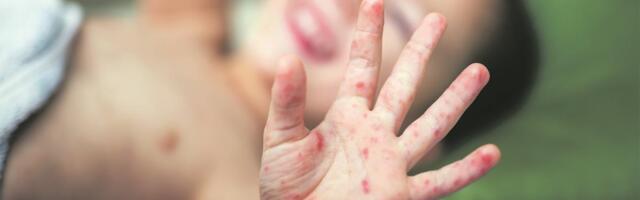 Ako primetite bubuljice kod deteta, hitno kod lekara! Novi virus širi se enormnom brzinom - simptomi su podmukli, može da izazove poremećaj opšteg stanja