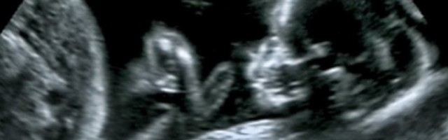 Beba rođena u Iraku krajem prošle godine ušla je u istoriju kao prvi zabeleženi slučaj čoveka sa 3 različita penisa