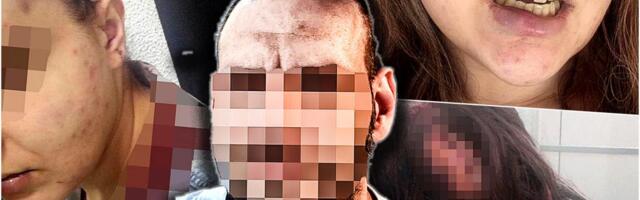 "TUŽITELJKA U SVOJOJ KARIJERI NIJE IMALA TEŽI SLUČAJ OD MOG" Produžen pritvor nasilniku koji je na Kanarevom brdu zverski pretukao ženu!