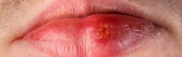 Ovo na usnama može biti znak raka: Deluje kao obična promena, a ustvari je mnogo gore