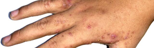 NPS: Vlast ignoriše da se šuga pojavljuje u kolektivima u kojima su zaposleni strani radnici