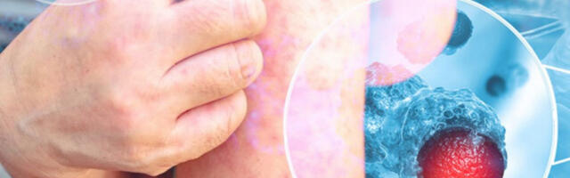 VIŠE OD 1.100 SLUČAJEVA MALIH BOGINJA! Zabrinjavajuče prognoze - mogući i smrtni ishodi!