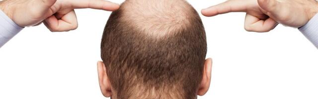 Predsednik Južne Koreje predložio: Razmotriti pokriće gubitka kose javnim osiguranjem