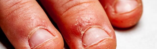 Odvratan razlog zbog kog ne bi trebalo da grickate nokte