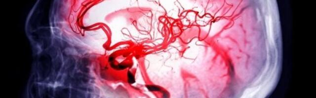 Spasite sebe pucanja aneurizme na mozgu: Prepoznajte simptome pre nego što bude prekasno