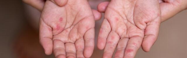 Na udaru nevakcinisana deca: Epidemija morbila u Pazaru ne jenjava