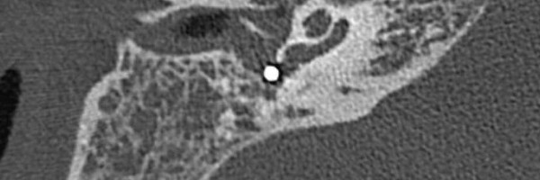 Varioc zbog nepažnje umalo ostao bez sluha