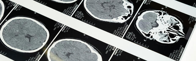 Neuralink konkurencija: Još jedan čip za ljudski mozak