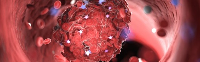 Kako prepoznati simptome krvnih ugrušaka?