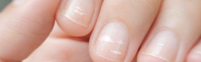 Šta vam izgled noktiju govori o zdravlju?