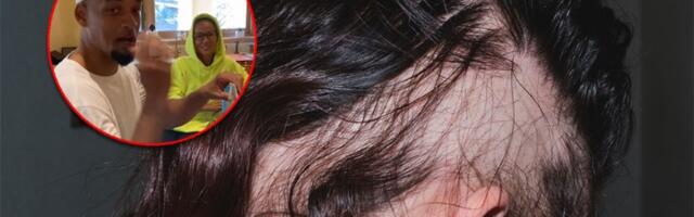 Šta je alopecija? Skandal na Oskaru dokaz da nije šala