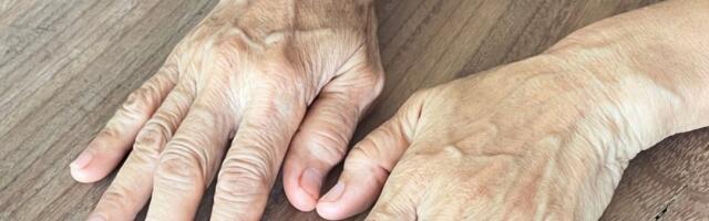 Ispupčene vene na rukama nisu bezazlene: Evo na šta ukazuju i kada je vreme za alarm