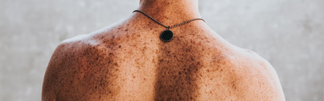 ABCD pravilo – Kako prepoznati rak kože