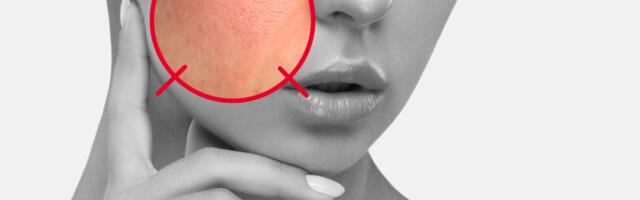 Ovih 6 stanja kože se ipak ne mogu izlečiti