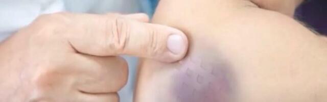 NE OSETITE UDARAC, A MODRICA JE TU! Evo kada je situacija ozbiljna - telo šalje signale koje ne smete ignorisati!