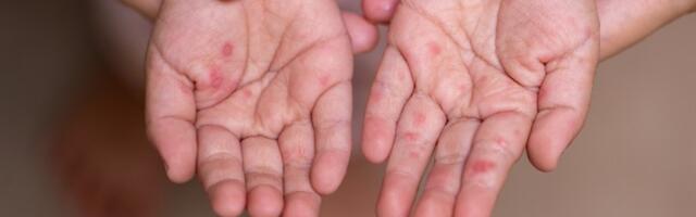 Majka i sin se zarazili malim boginjama