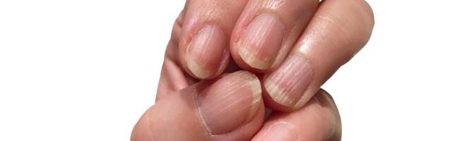 Šta zapravo znači kada vam se pojave brazde na noktima: U ovim slučajevima je ALARMANTNO