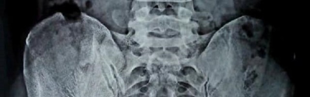 Ruskinja Nataša Demkina tvrdi da je dama sa rendgenskim očima!