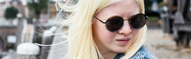Roditelji su mislili da je prokleta zato što je rođena kao albino i ostavili je ispred sirotišta, a danas pozira za Vogue