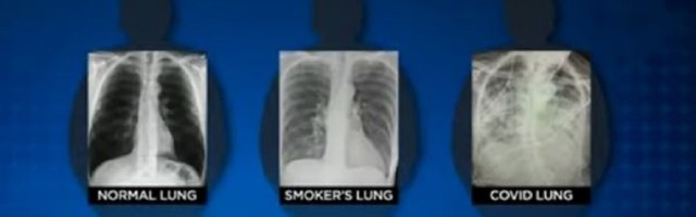 Post-kovid pluća gora od pluća pušača