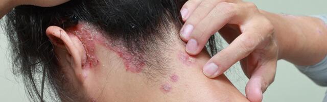 Bolest može biti i do 10 godina u telu dok se ne ispolji: "Biblijska zaraza" se pojavila u regionu, odmah se oglasila naša struka, ovo su simptomi