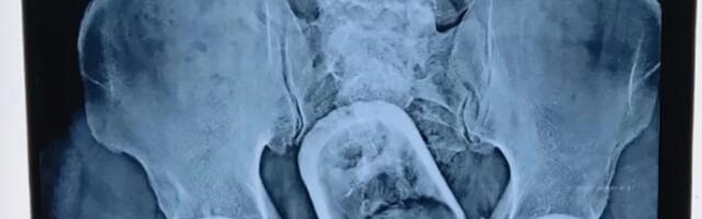 Čovek sa čašom u utrobi kaže da ju je slučajno progutao