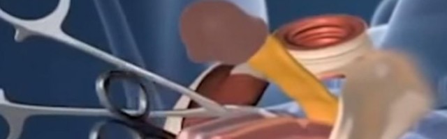 Šokanto! Neobičan medicinski slučaj u Kini! Posle 25 godina otkrila da je muško!