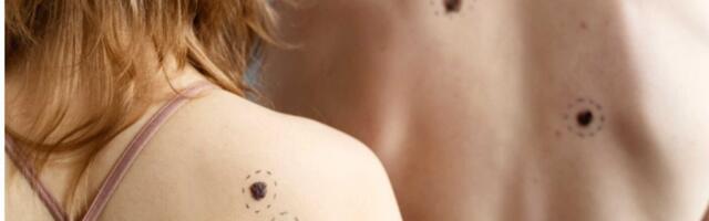 U subotu u niškom Domu zdravlja akcija preventivnih pregleda mladeža i promena na koži