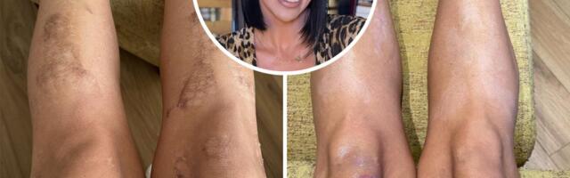 Hristina je otišla na epilaciju, a izašla sa stravičnim opekotinama: "Osam meseci sam krila noge"