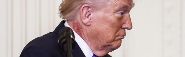 Oglasio se Trampov lekar: Evo odakle mu ova krasta na vratu! (FOTO)