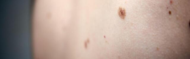 NA OVE PROMENE SE NE ŽMURI, ŽIVOT MOŽE BITI UGROŽEN! Zašto je proleće idealno vreme za kontrolu mladeža?