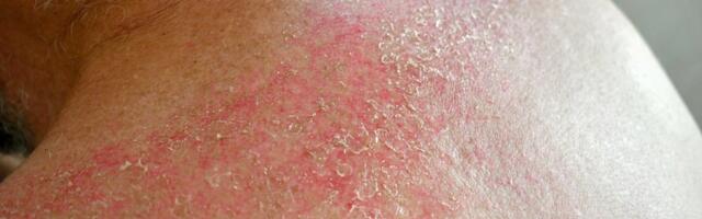 Preti li pandemija? Hitno se oglasio Batut povodom situacije sa gubom u Srbiji