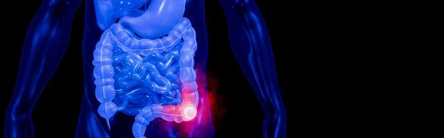 Zašto sve više mlađih ljudi oboleva od raka debelog creva? Epidemiološki obrt zabrinuo naučnike