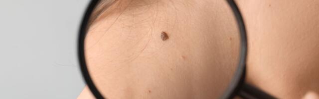 Ove pege na rukama nemaju veze sa godinama, ali imaju sa suncem: Idite na besplatni pregled mladeža