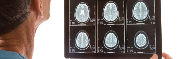 Neobjašnjiva bolest mozga koja uzrokuje cvokotanje zuba i halucinacije zbunjuje doktore!