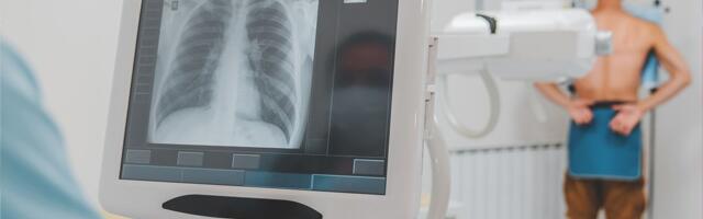 U Srbiji svake godine od raka pluća oboli oko 7.000 ljudi uprkos organizovanom skriningu