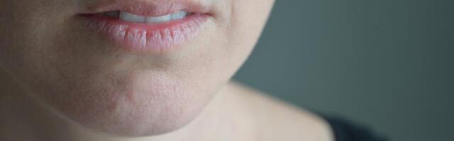 Ranice u uglovima usana koje niko ne shvata ozbiljno! Godinama imate ŽVALE, a lekari ćute? PROČITAJTE OVO!