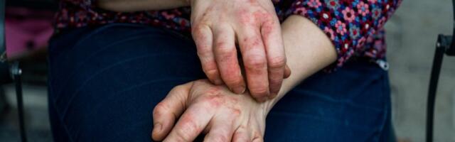 Obuzdajte ekceme na koži: Spasite se od bolnog svraba uz par trikova koji provereno deluju