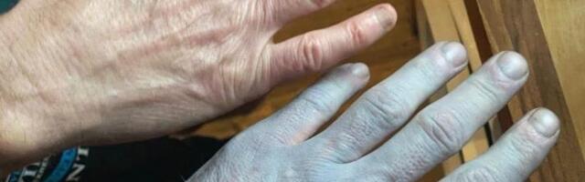 Probudio se potpuno plav i hitno otišao u bolnicu: Nakon pregleda lekari su počeli da se krste od prizora