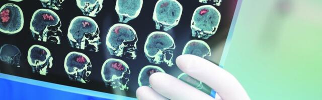 Ljudi sa ovom krvnom grupom imaju najveće šanse da dožive šlog: Doktori otkrili frapantne rezultate