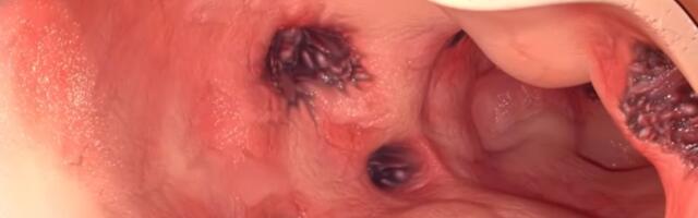 VIDEO: Većina ljudi do 80. godine razvije divertikulozu u crevima - šta je to?