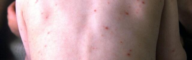 Dve nedelje od smrti dečaka (9) i dalje nema nalaza obdukcije! Imao boginje i temperaturu, lekar ga poslao kući