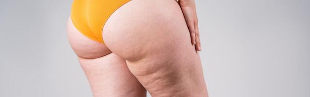 Celulit: Mala udubljenja, veliki problemi i još veća zarada