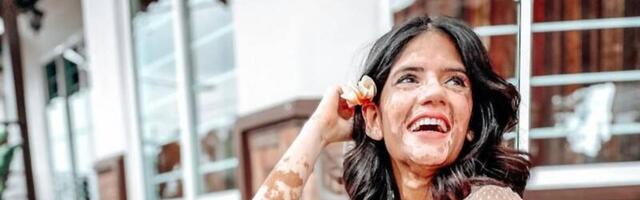 Sonja od osme godine ima vitiligo i zbog njega loše detinjstvo: Teško sam naučila da volim sebe i da se izborim sa nadimkom dalmatinca