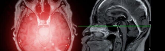 Razvijen novi preparat za dijagnostiku i lečenje glioma
