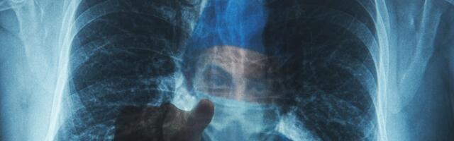 Dogodilo se nemoguće: Pacijent živeo bez pluća punih 48 sati! Neverovatan uspeh hirurga